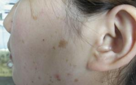 皮肤癌的症状,症状识别与早期预防关键